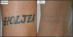 Tattoo Removal w/ Picosure- Melbourne Fl