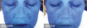 Before After Hydration