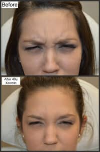Hydrafacial and Xeomin