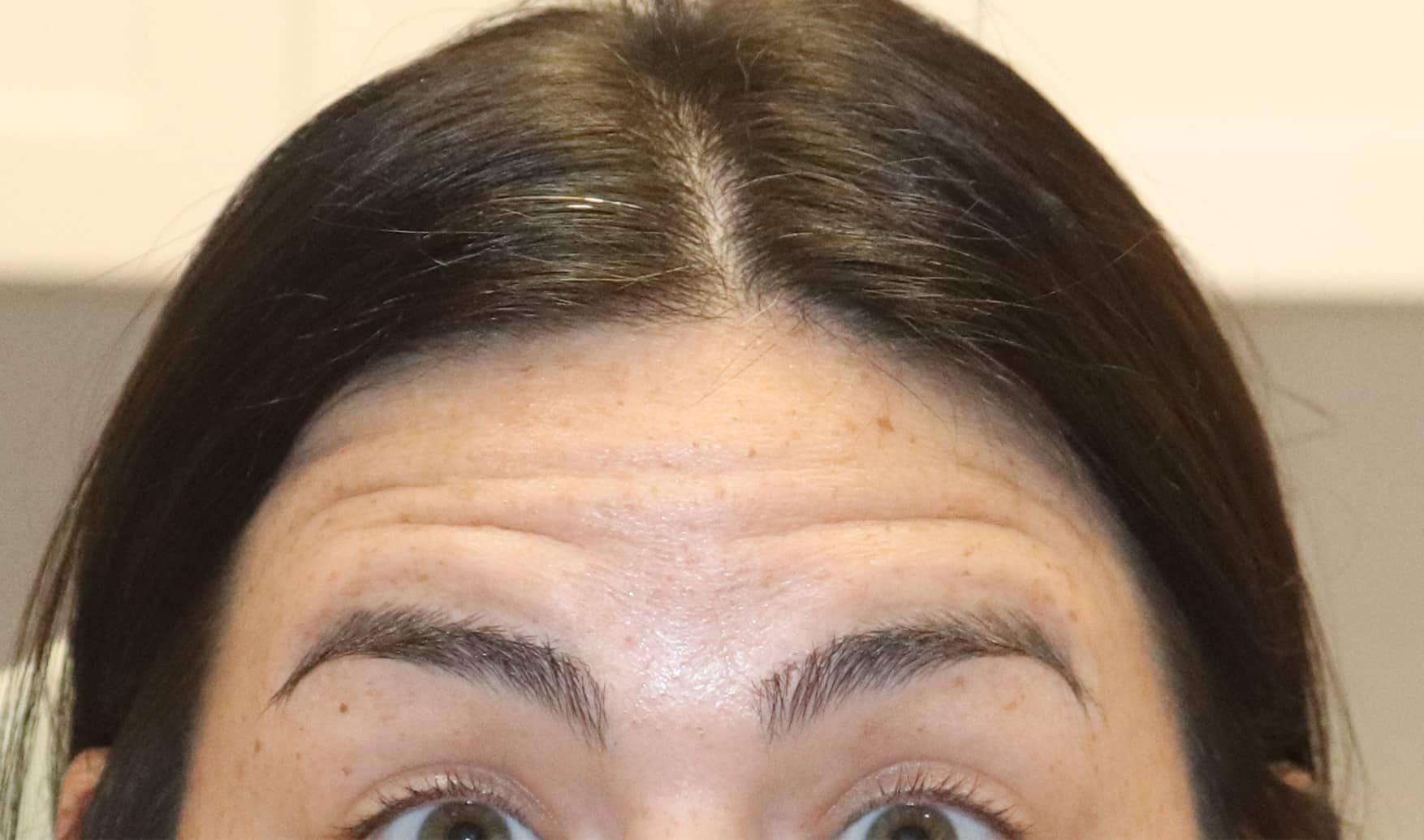Before Image: Xeomin - front