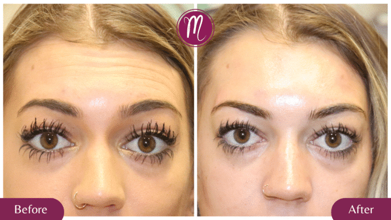 AD BA Xeomin Xeomin Benefits: Natural Results, 3x Points, and Why It’s Your Wrinkle Solution!"