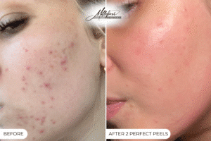 laser and peel treatments