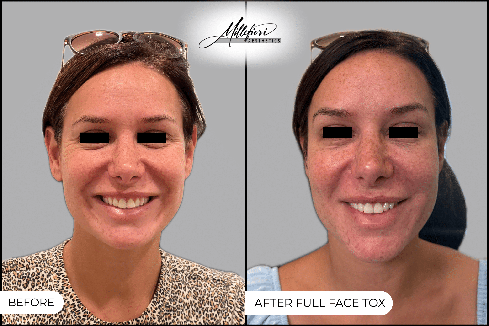 Michaelle F botox ✅