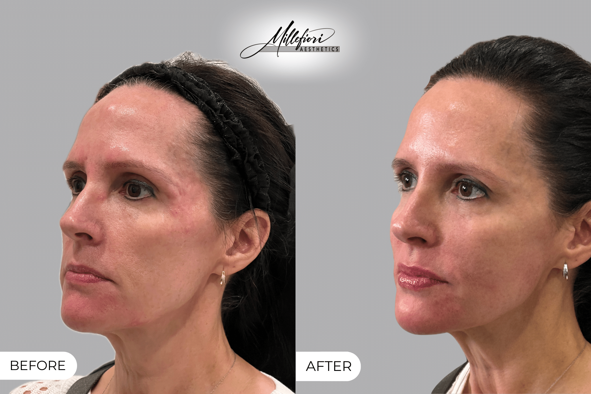 Before and After Image: Dermal Fillers - left-front-oblique