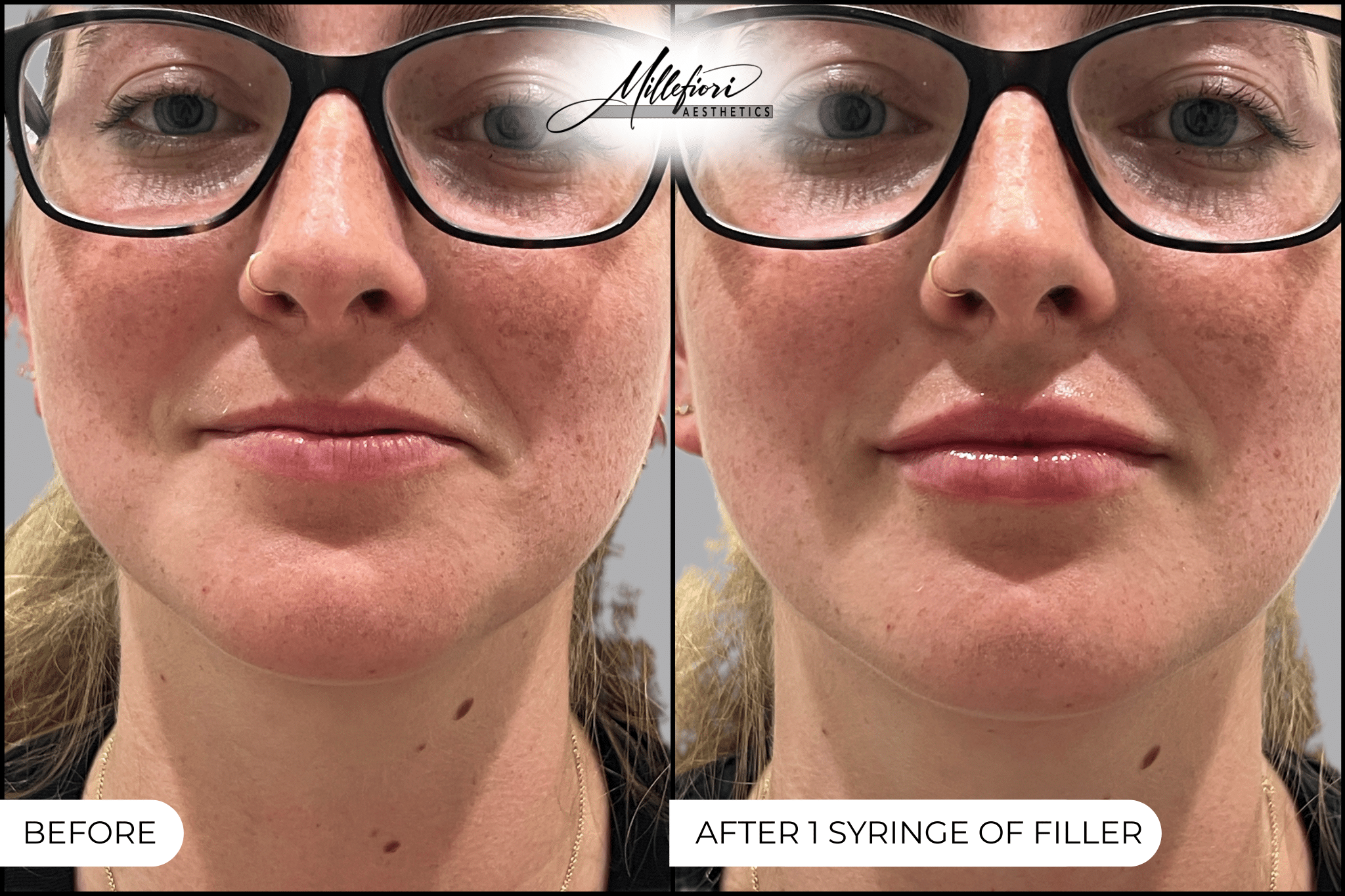 Before and After Image: Lip Filler - front