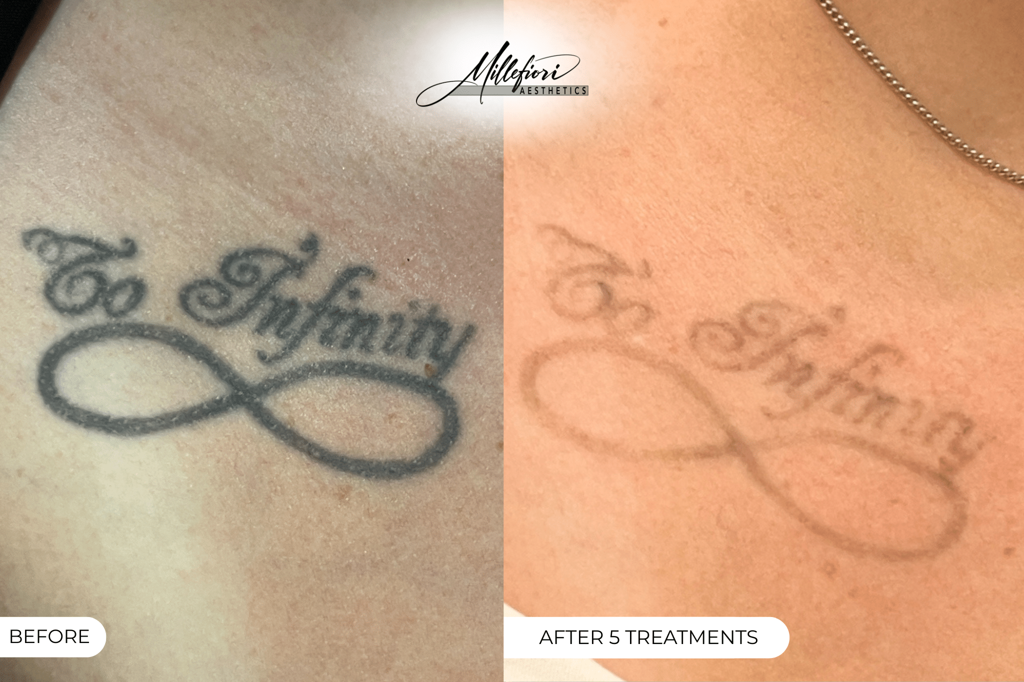 Before and After Image: Tattoo Removal - 