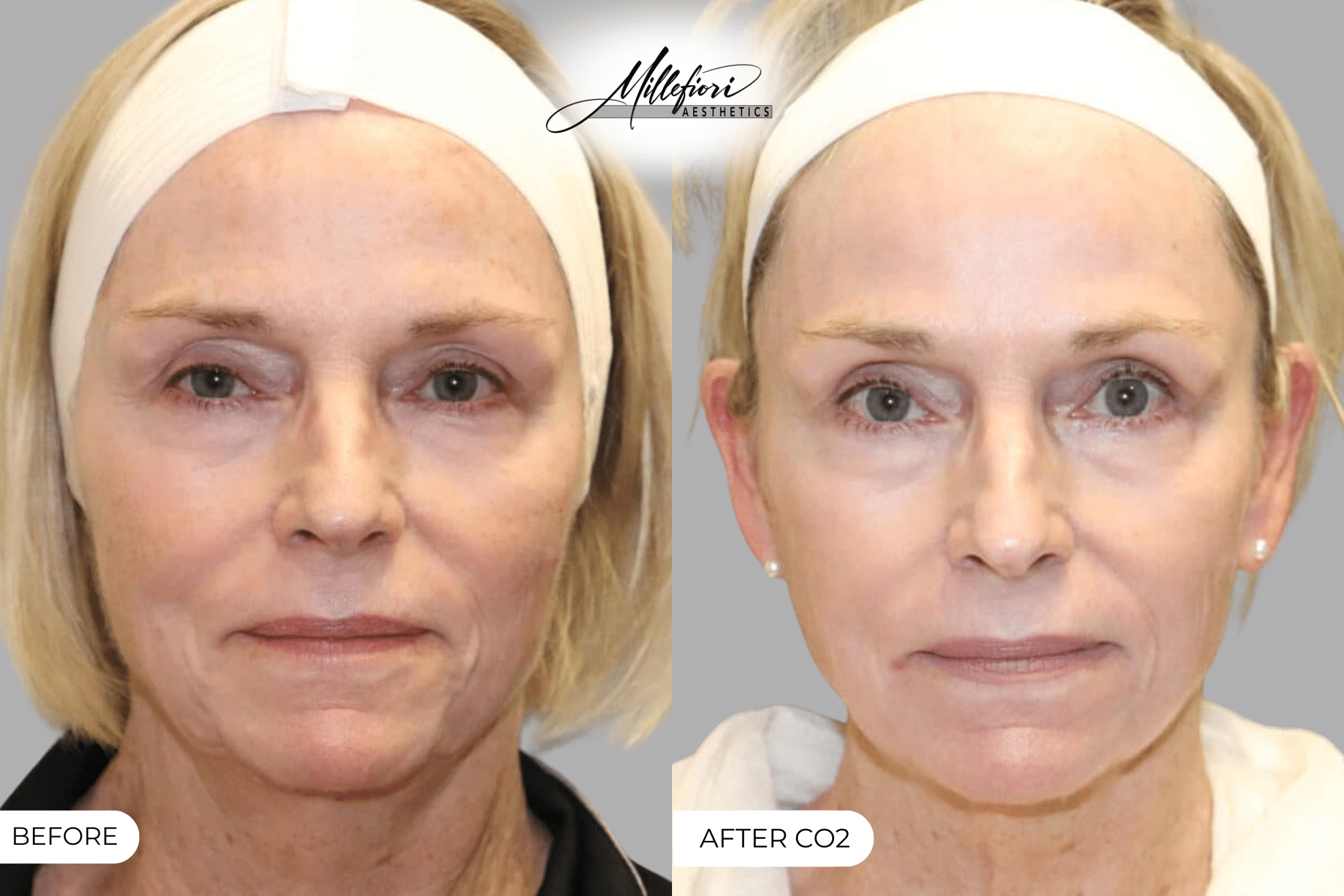 Before and After Image: Co2 Laser Resurfacing - front