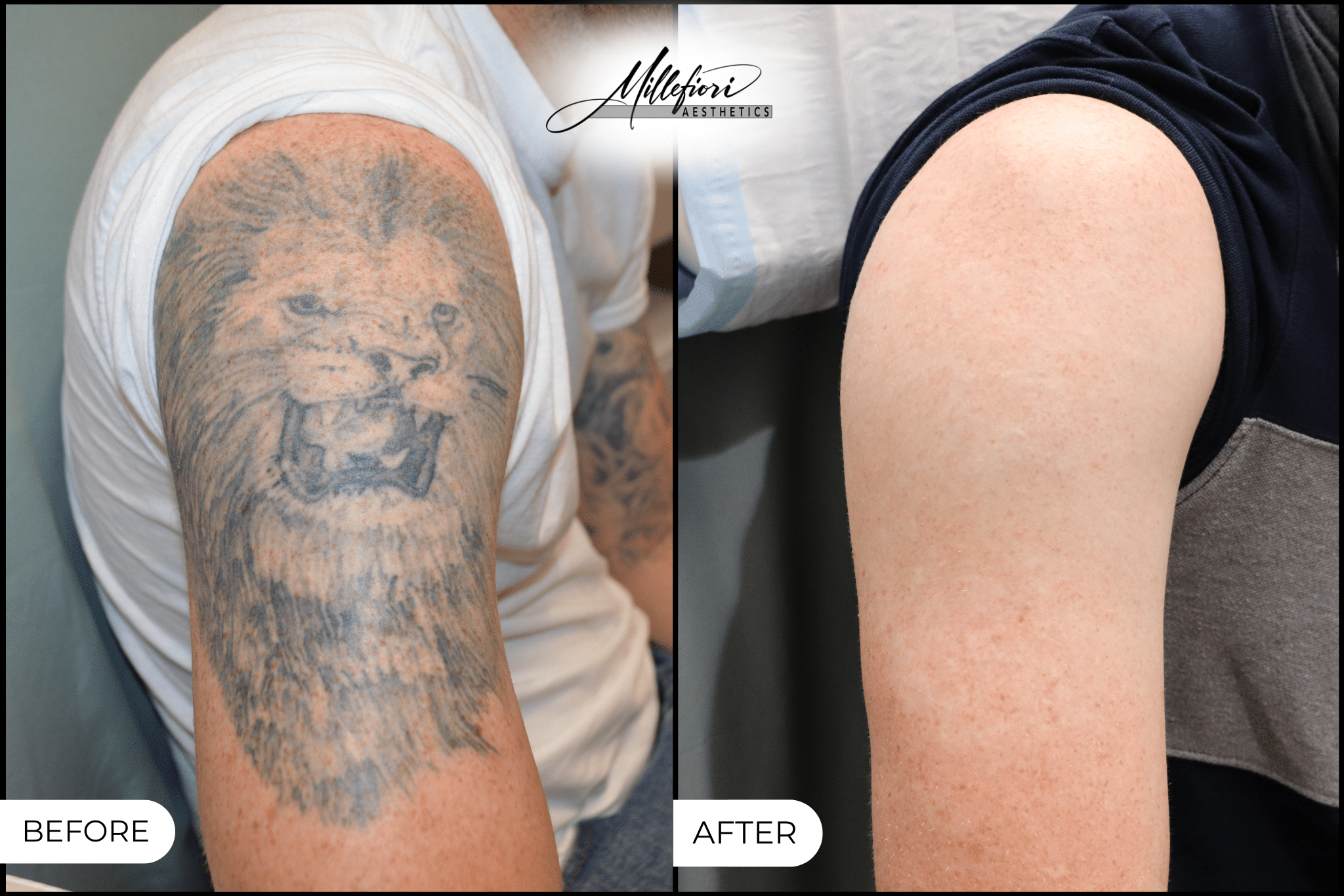 Before and After Image: Tattoo Removal - front