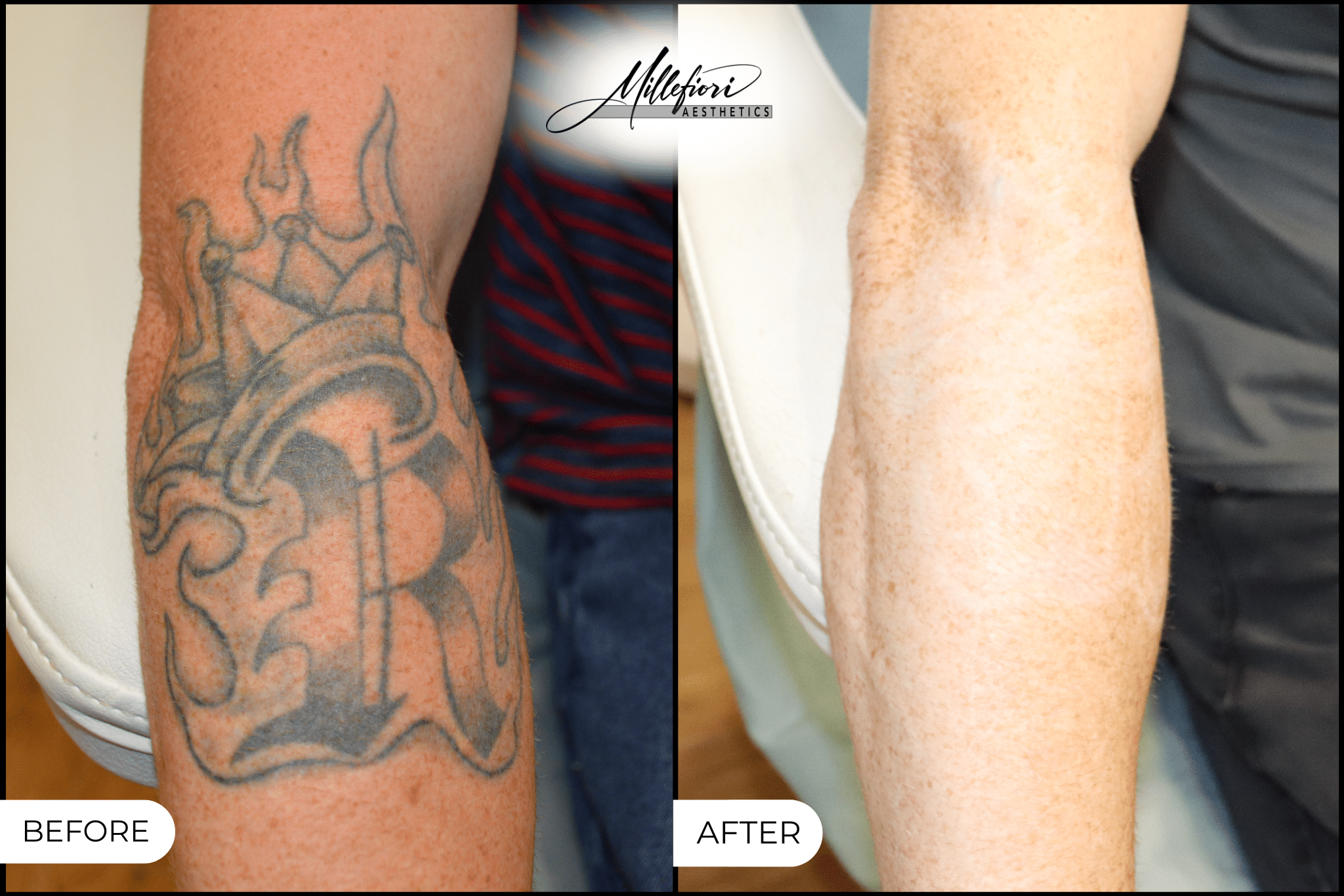 Before and After Image: Tattoo Removal - front
