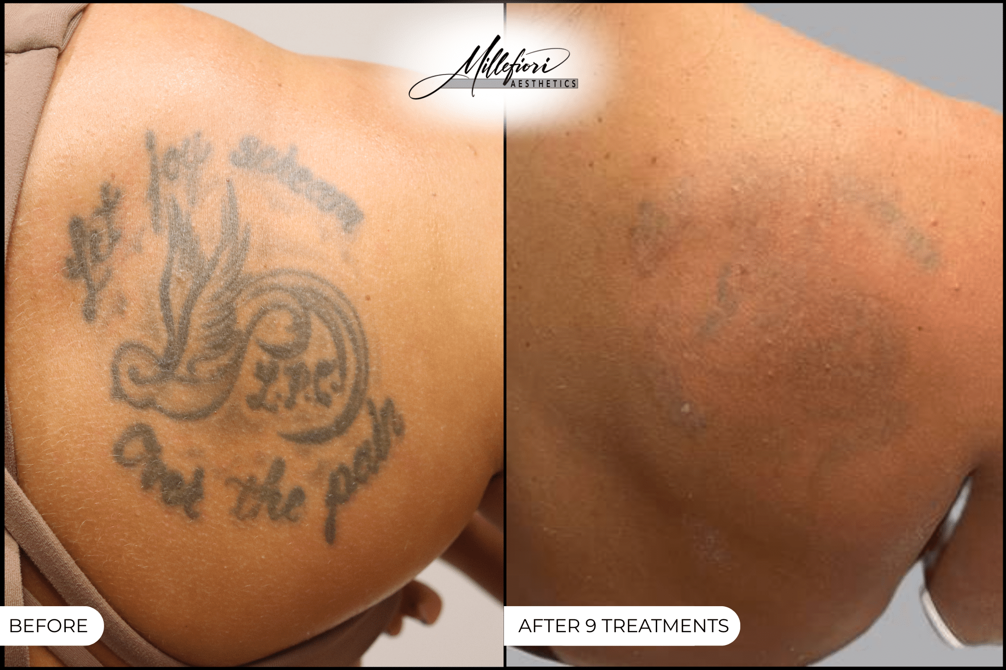 Before and After Image: Tattoo Removal - 