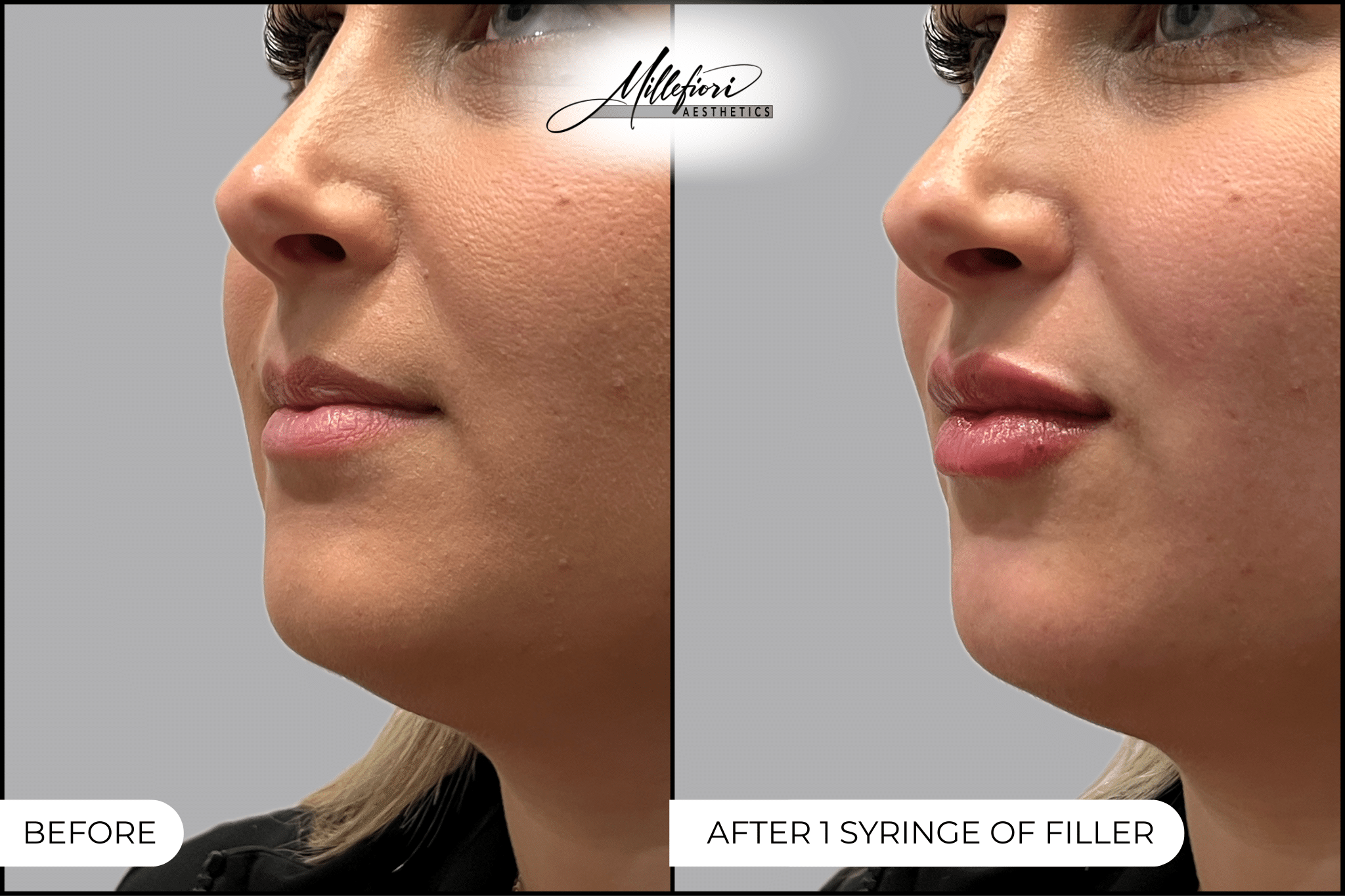 Before and After Image: Lip Filler - left-front-oblique