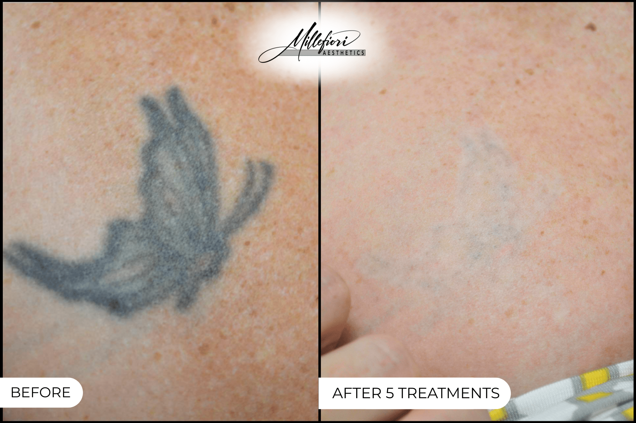 Before and After Image: Tattoo Removal - 