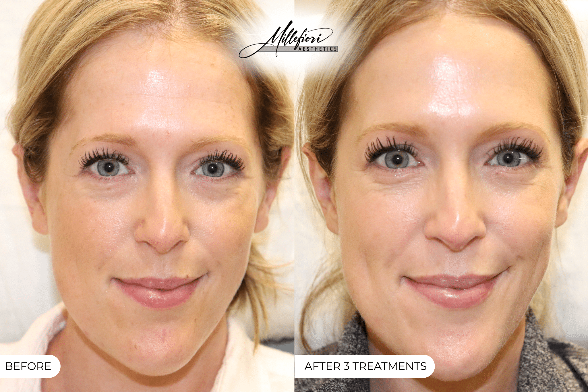 Before and After Image: PicoSure Laser