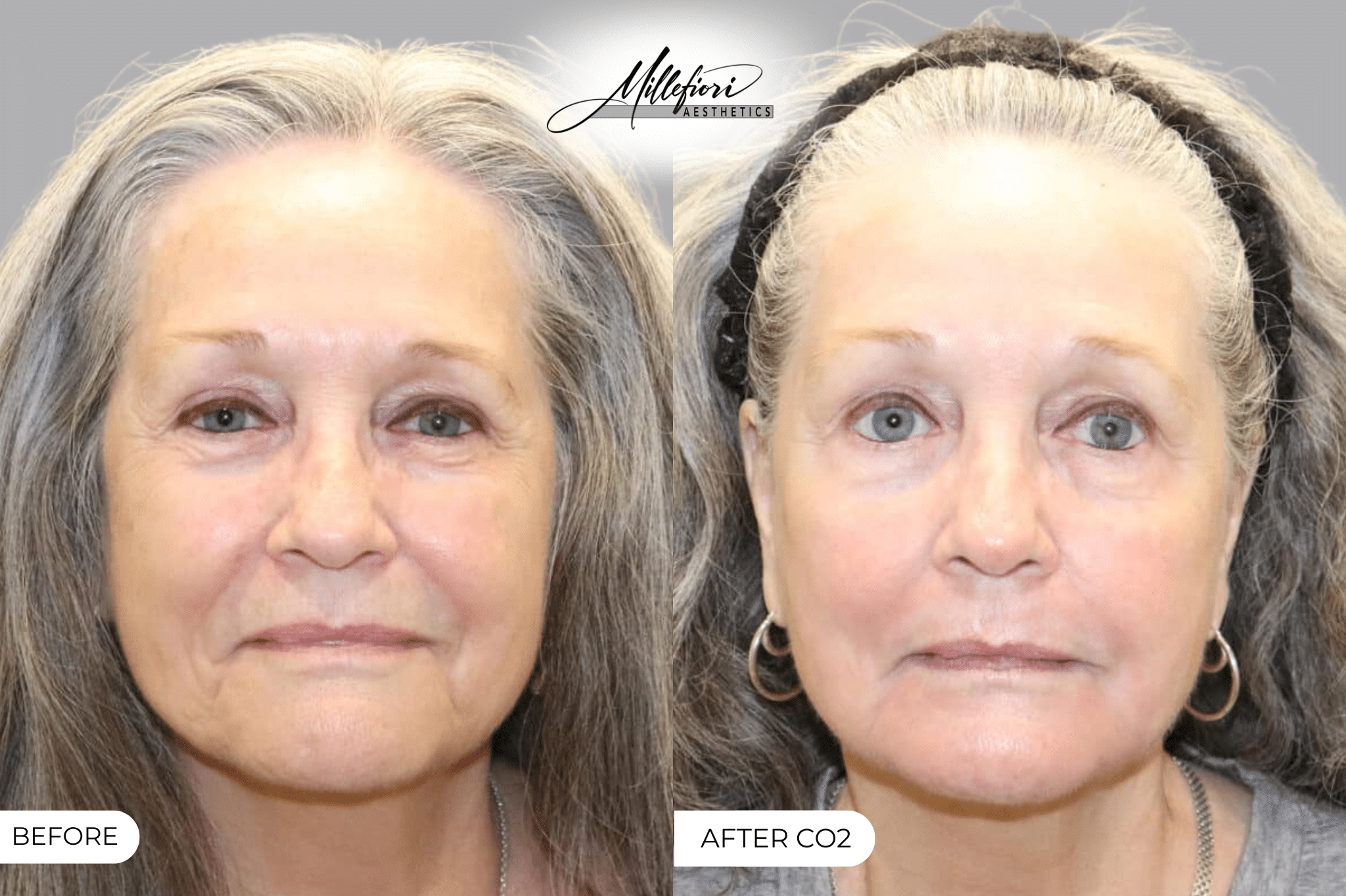 Before and After Image: CO2 Laser Resurfacing - front
