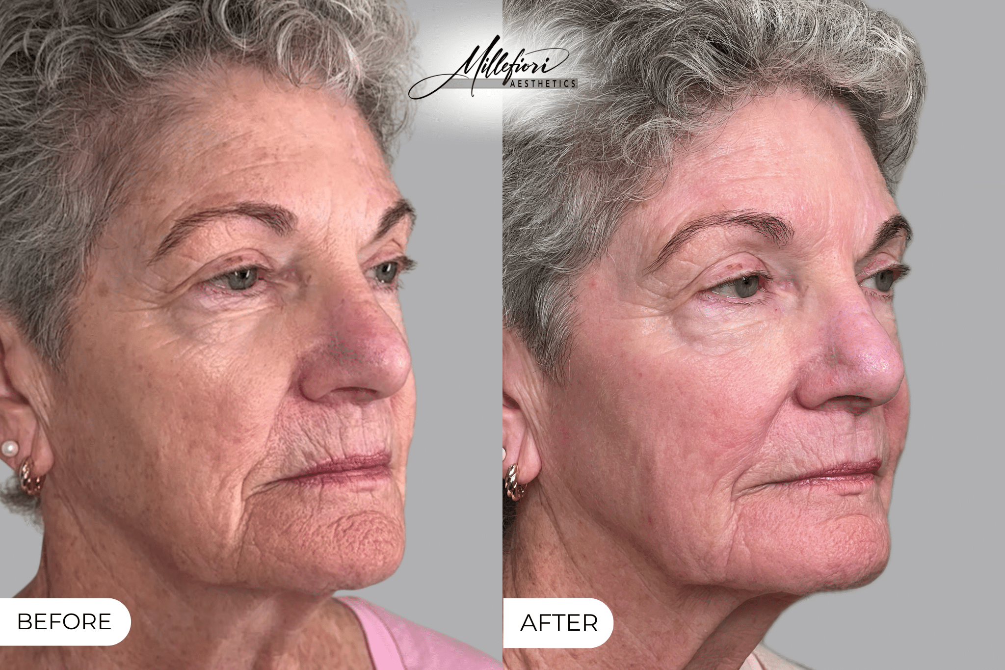 Before and After Image: Co2 Laser Resurfacing - right-front-oblique