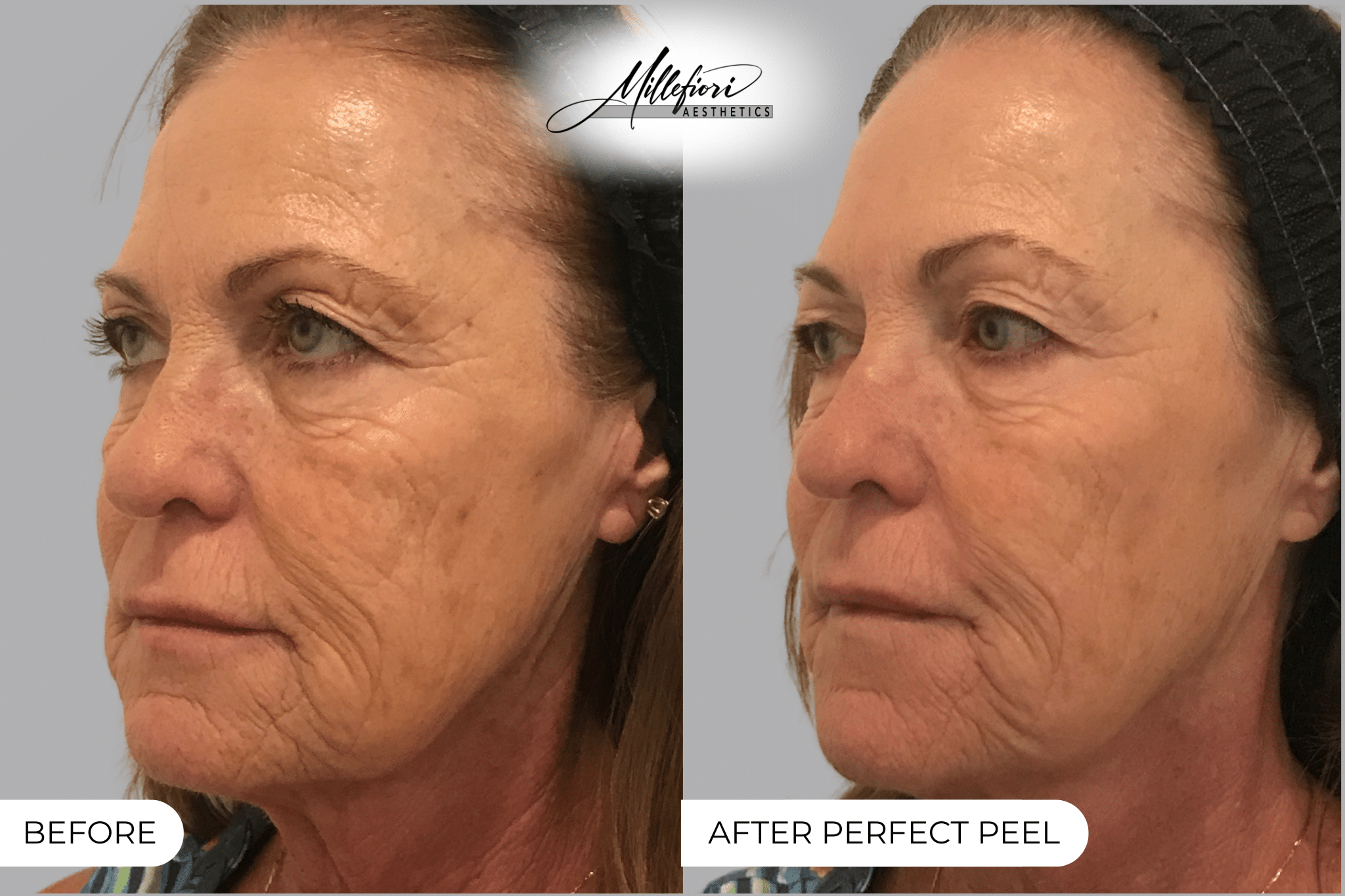 Before and After Image: Chemical Peel – Before & After (Case 1) - front