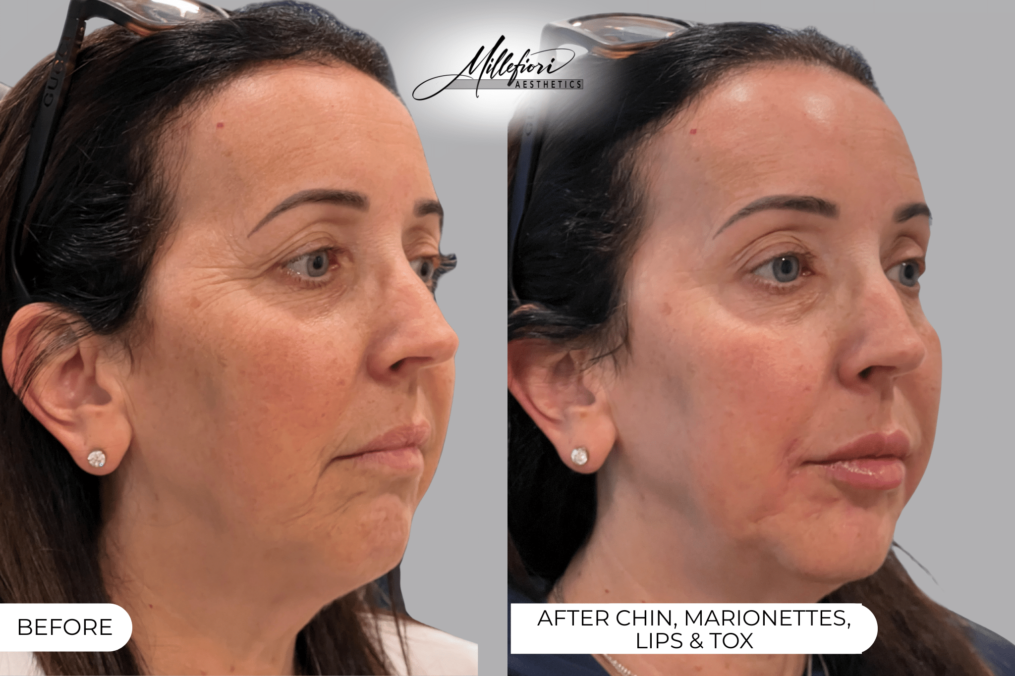 Before and After Image: Dermal Filler – Before & After (Case 1) - front
