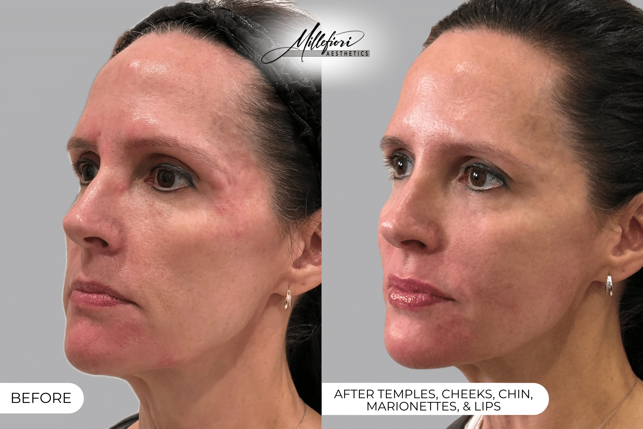 Before and After Image: Dermal Filler – Before & After (Case 2) - front