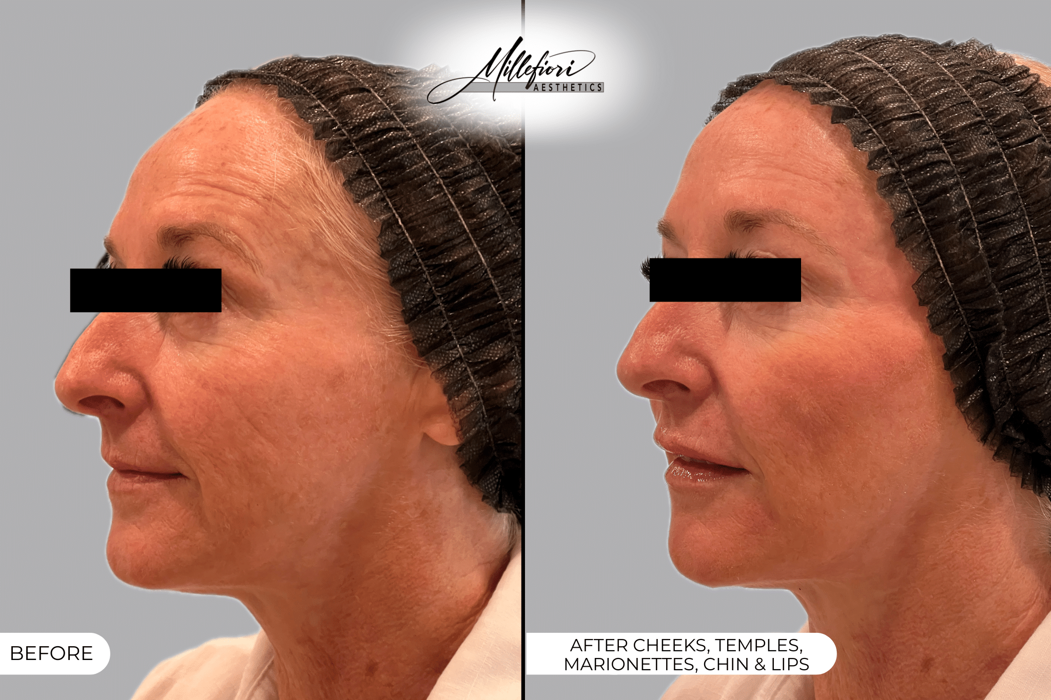 Before and After Image: Dermal Filler – Before & After (Case 3) - front