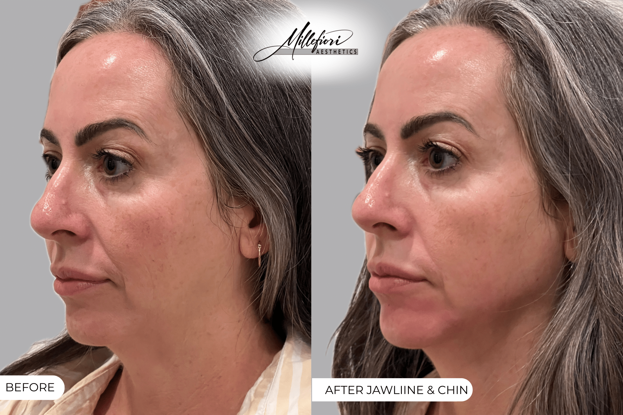 Before and After Image: Dermal Filler – Before & After (Case 4) - front