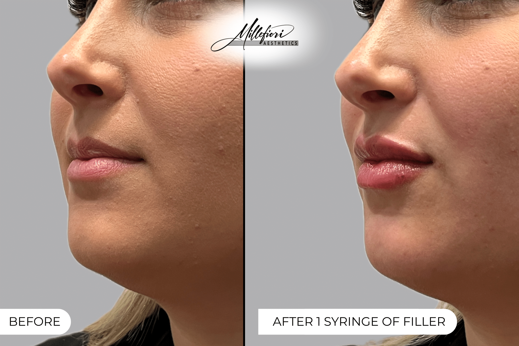 Before and After Image: Dermal Filler – Before & After (Case 5) - front