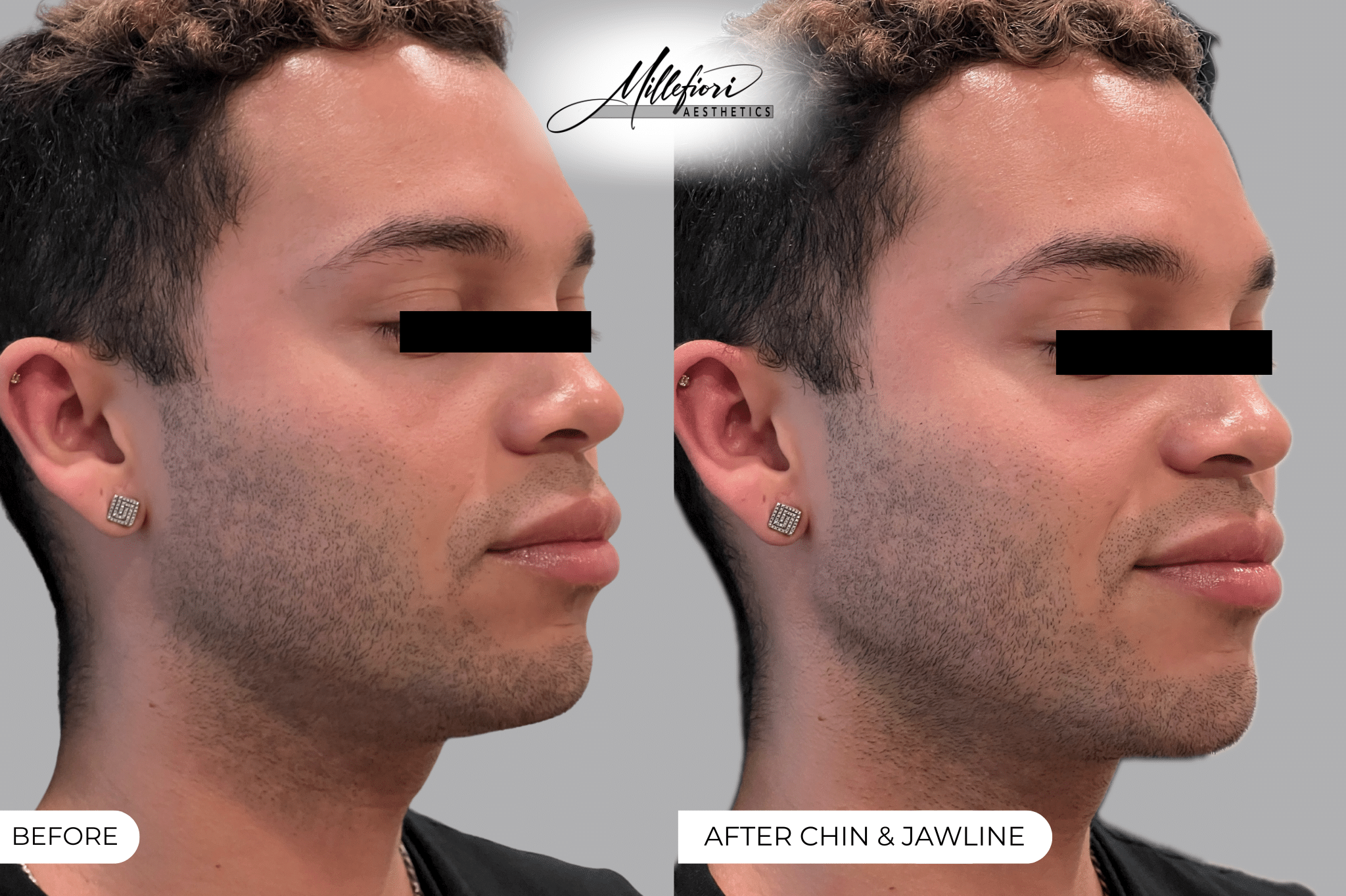 Before and After Image: Dermal Filler – Before & After (Case 6) - front