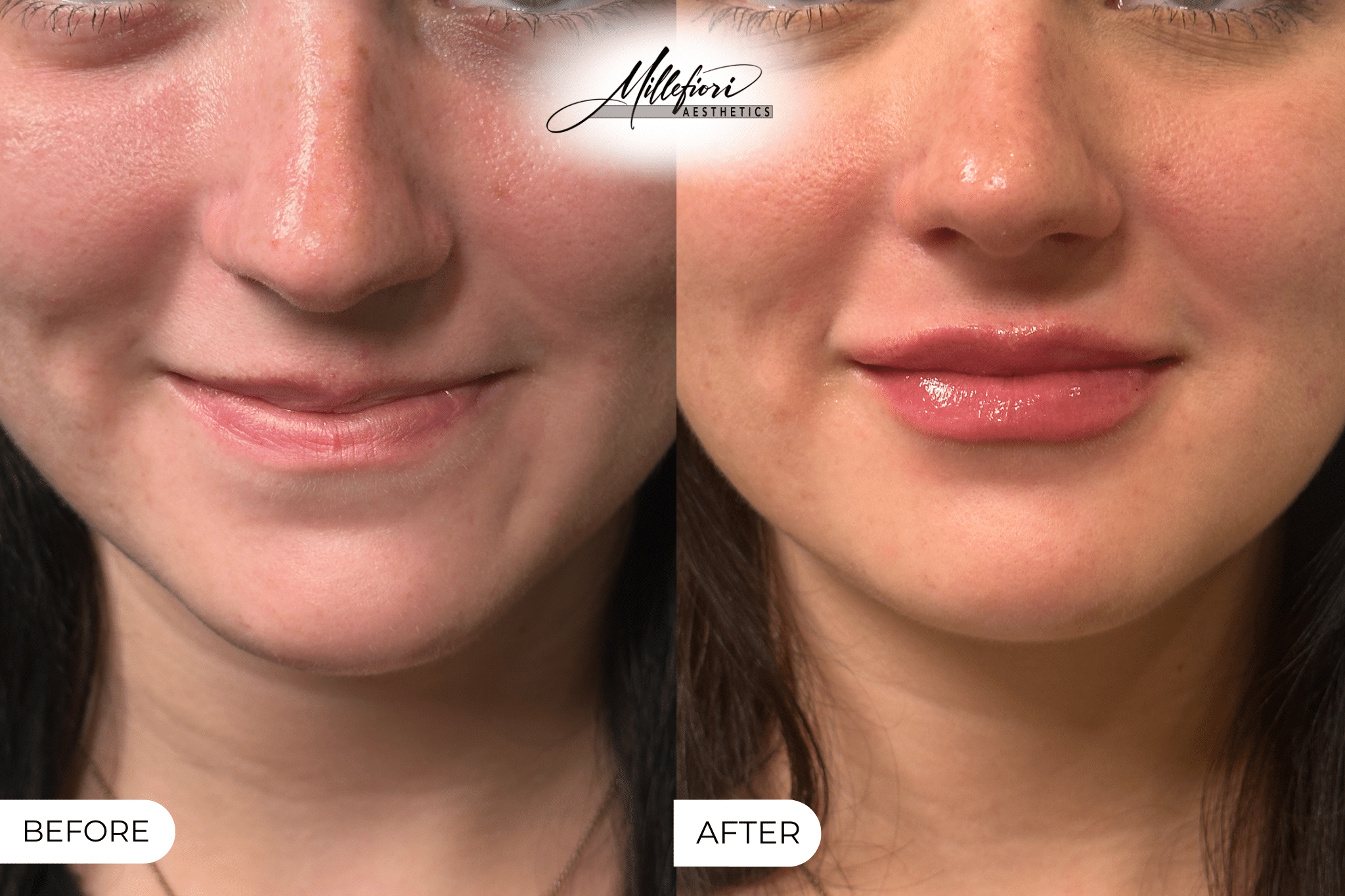 Before and After Image: Dermal Filler – Before & After (Case 7) - front