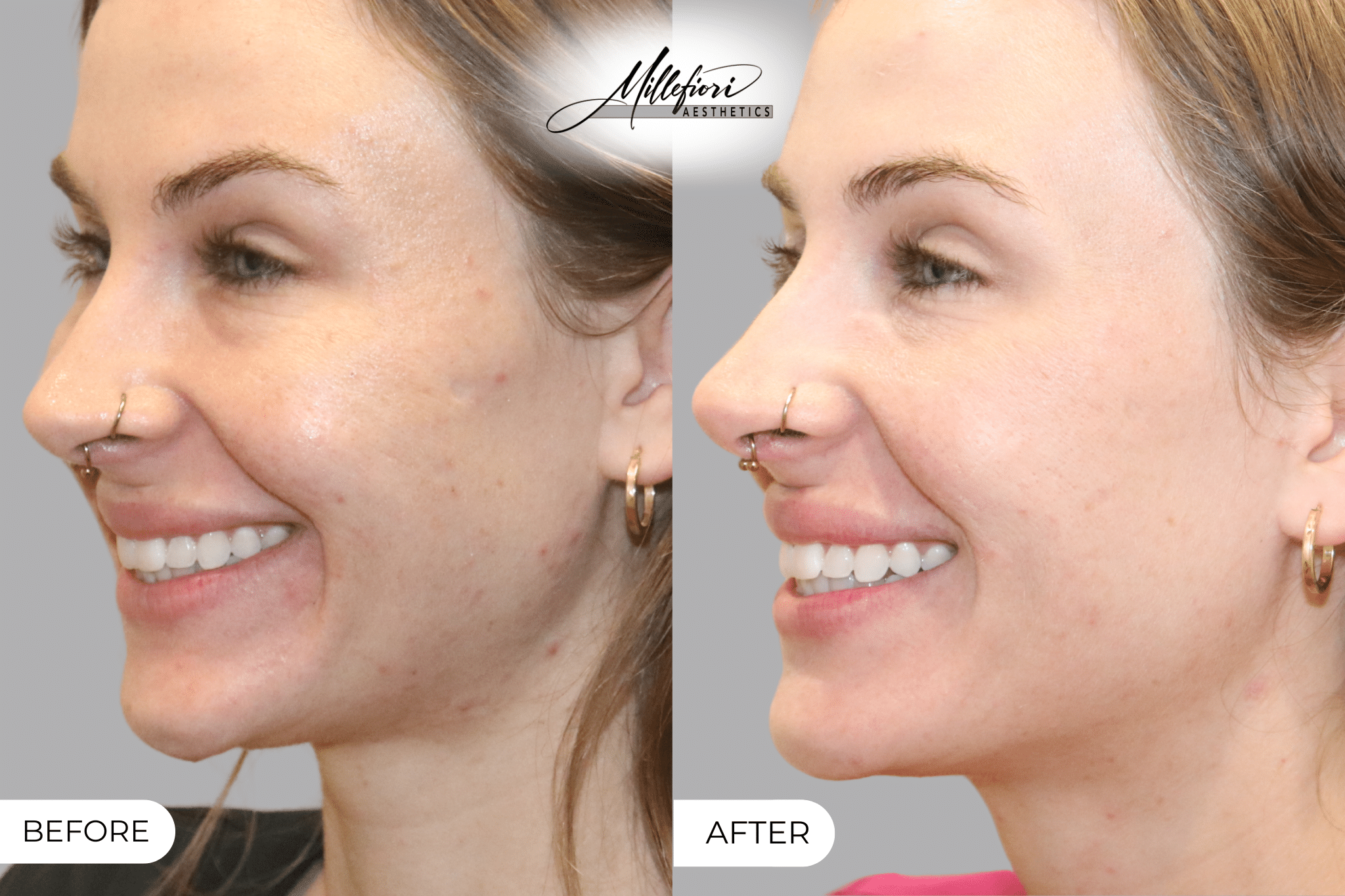 Before and After Image: Microneedling - front