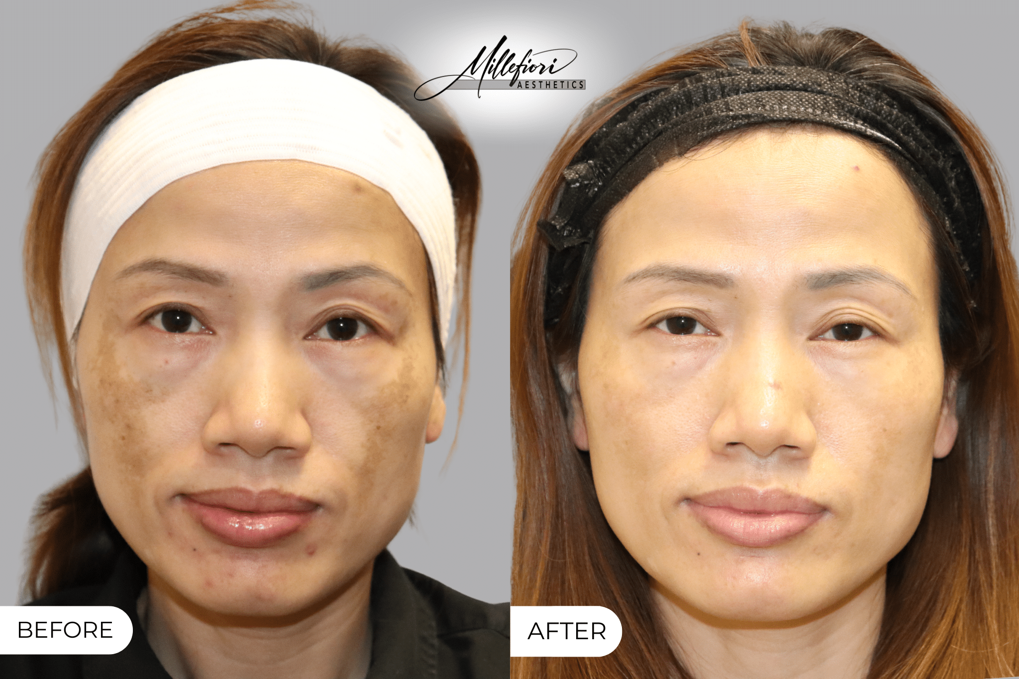 Before and After Image: PicoSure Laser – Before & After (Case 1) - front