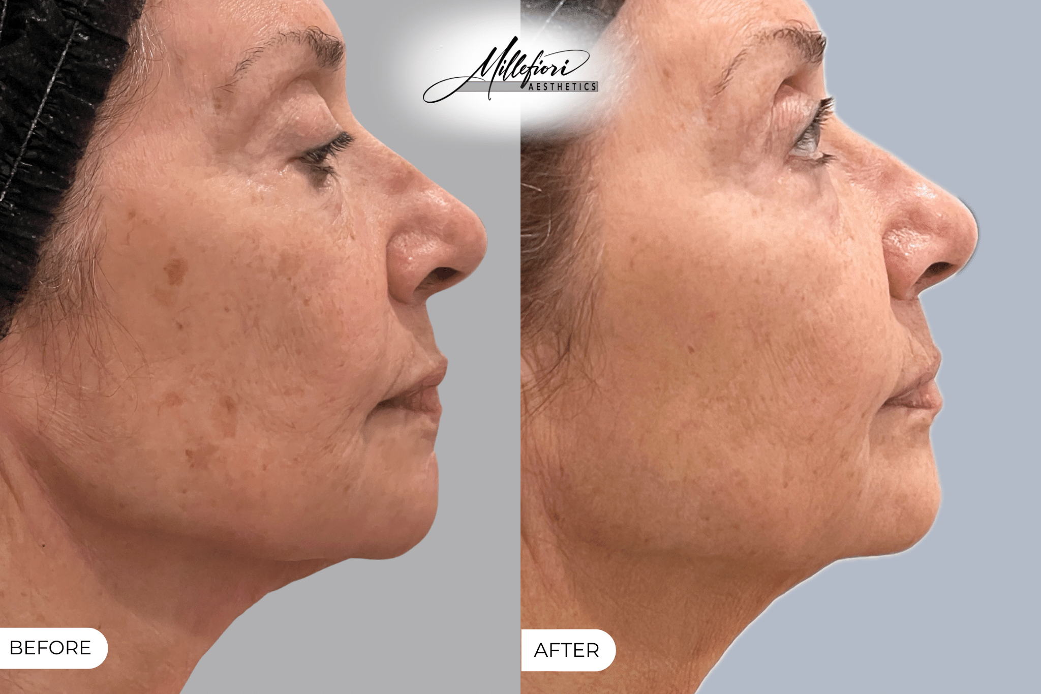 Before and After Image: PicoSure Laser – Before & After (Case 2) - front