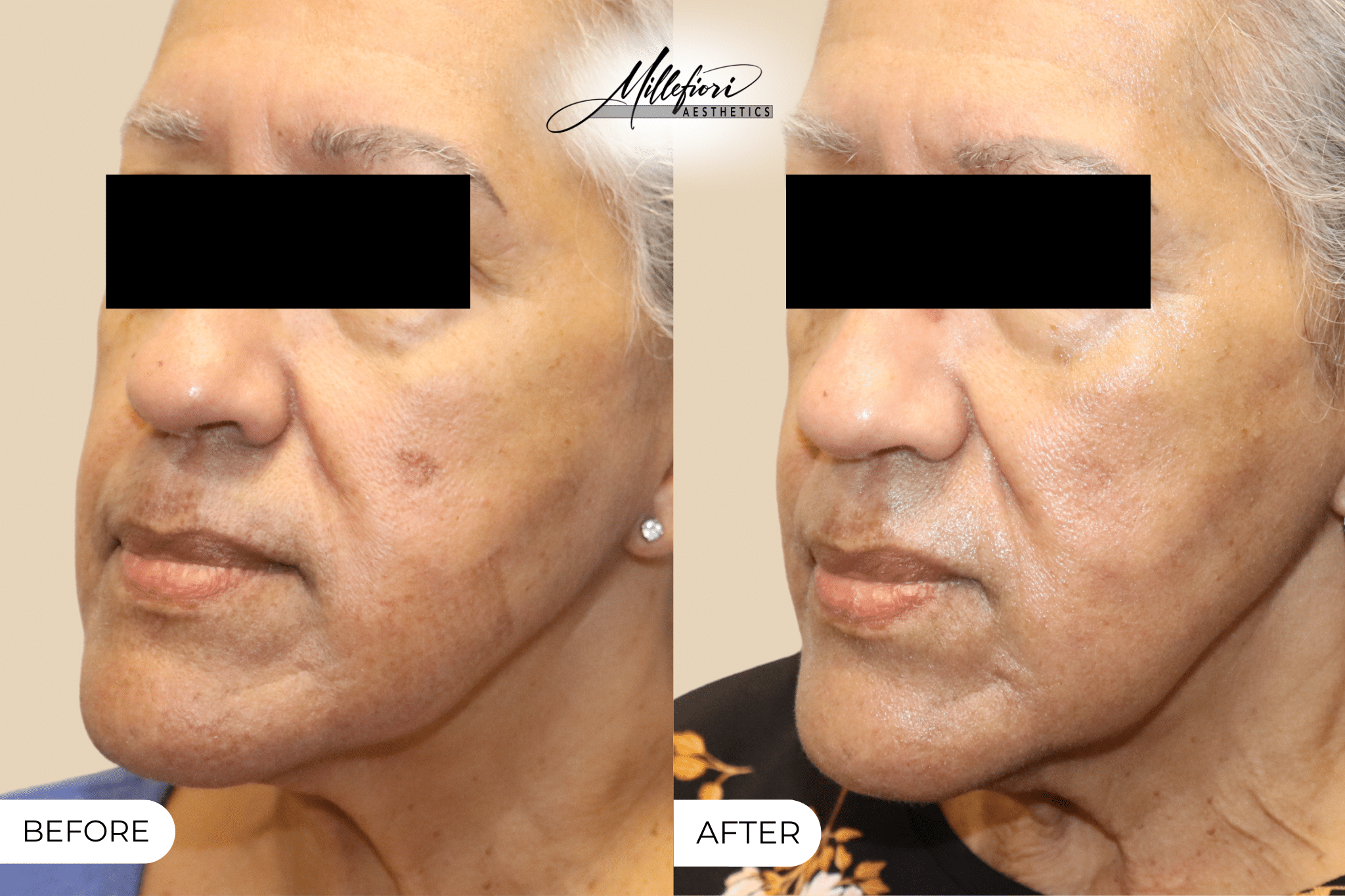 Before and After Image: PicoSure Laser – Before & After (Case 3) - front