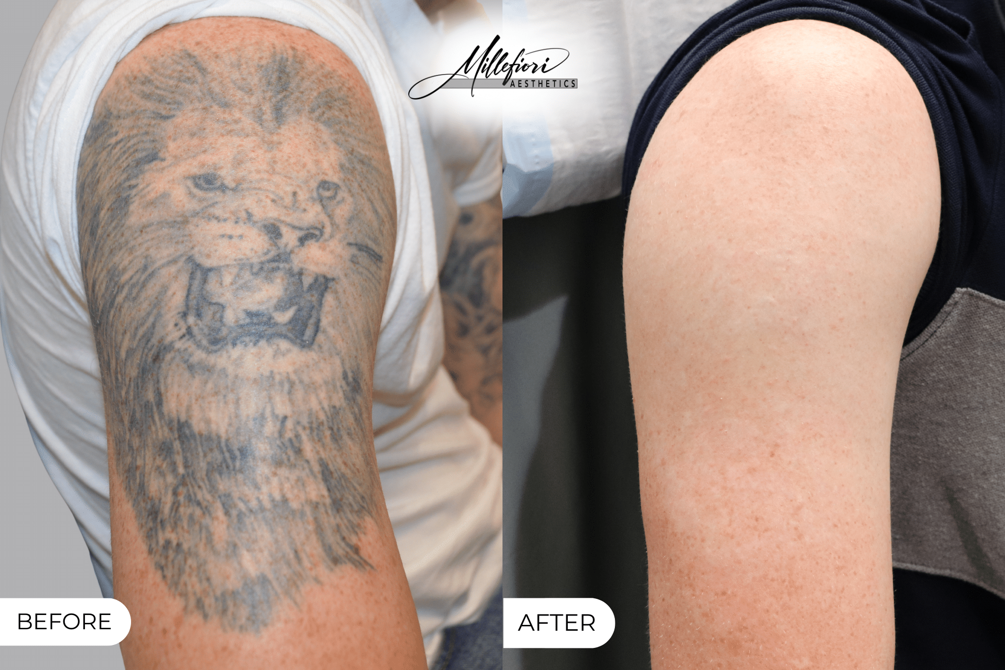 Before and After Image: Tattoo Removal – Before & After (Case 7) - front