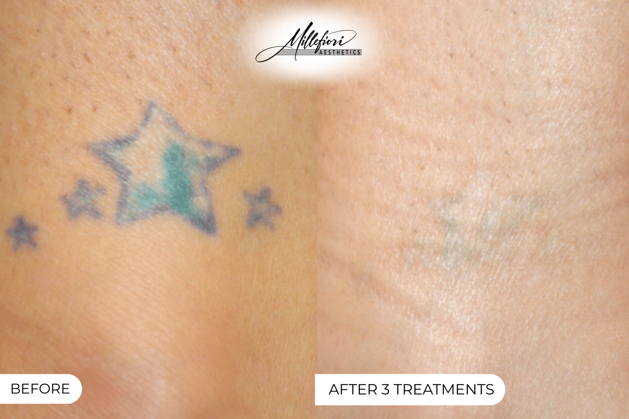 Before and After Image: Tattoo Removal – Before & After (Case 1) - front