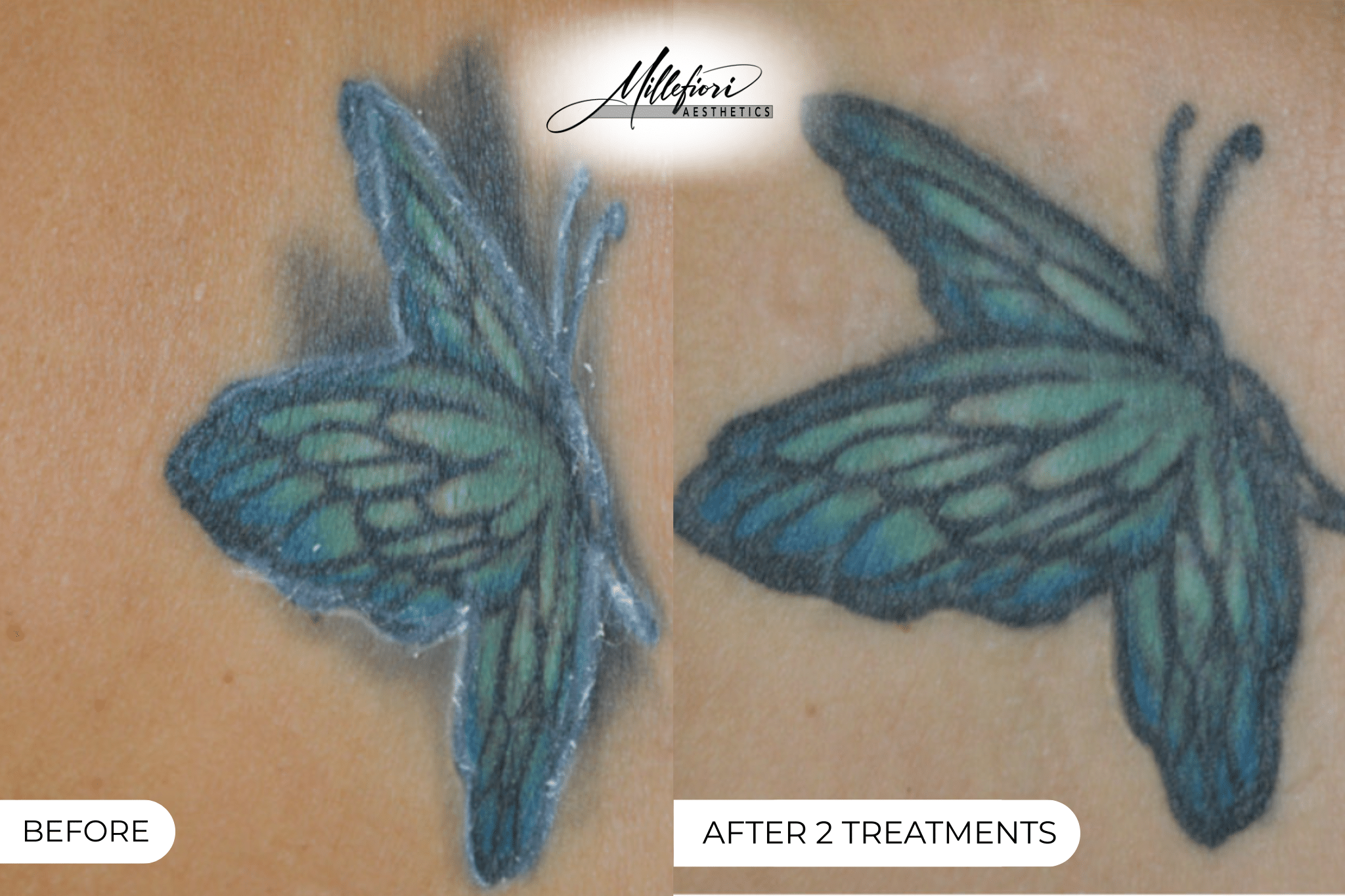 Before and After Image: Tattoo Removal – Before & After (Case 2) - front