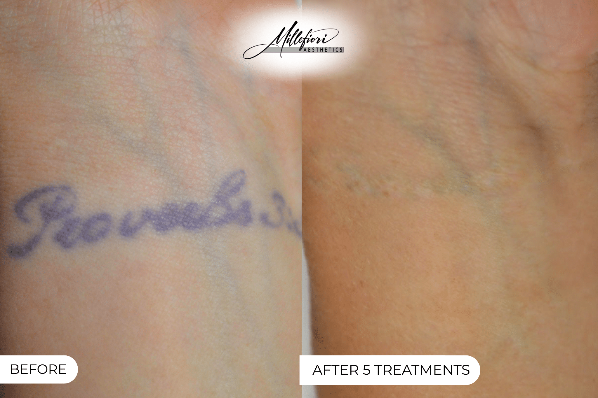 Before and After Image: Tattoo Removal – Before & After (Case 3) - front