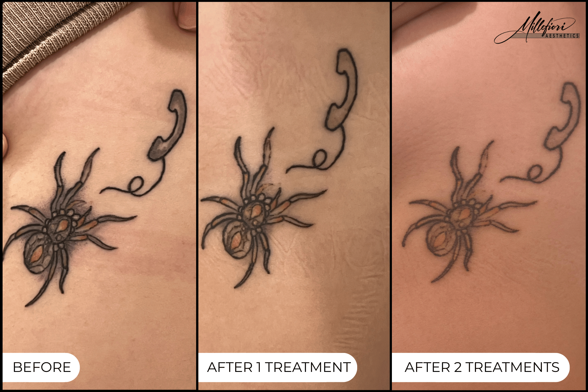Before and After Image: Tattoo Removal – Before & After (Case 4) - front