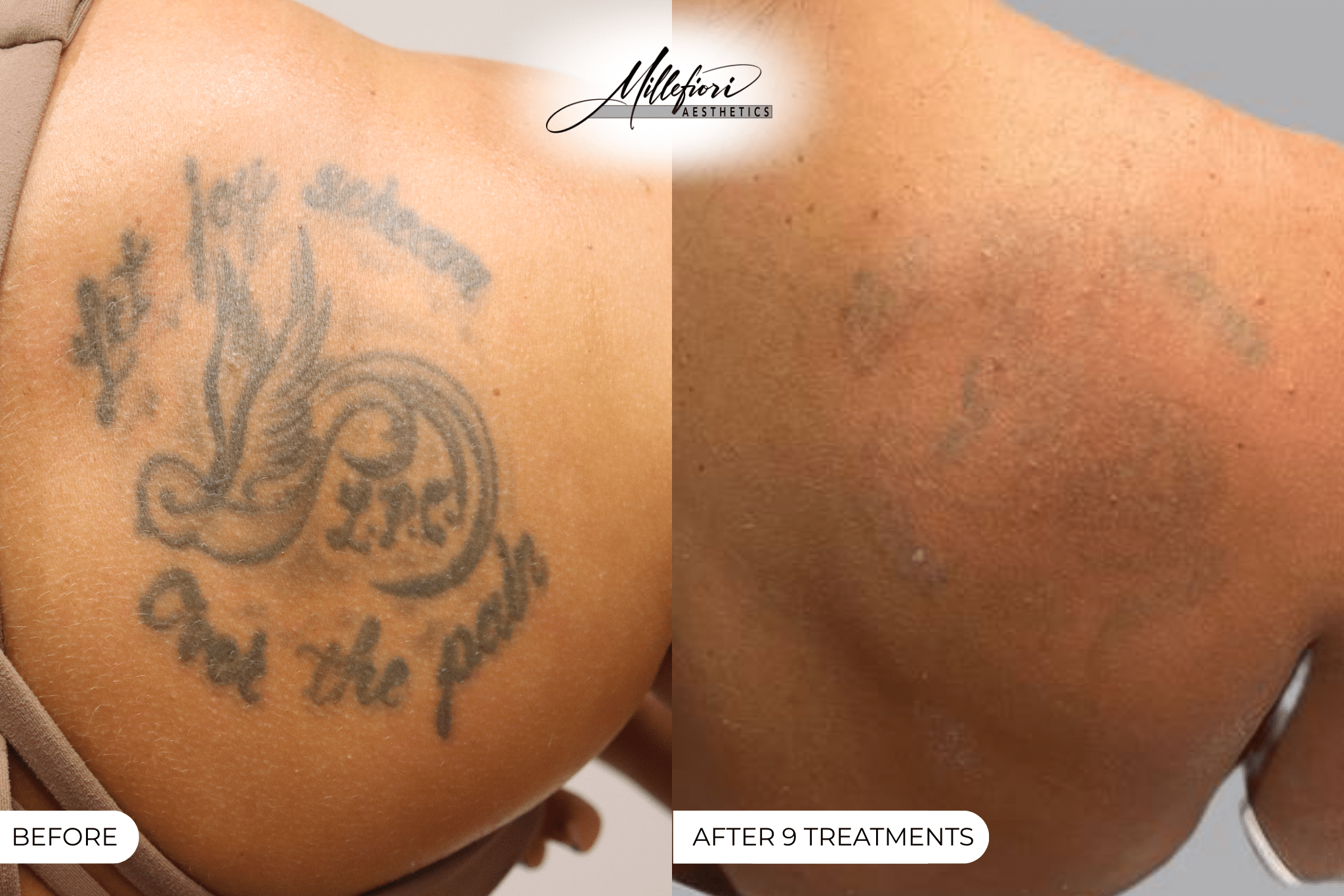 Before and After Image: Tattoo Removal – Before & After (Case 5) - front