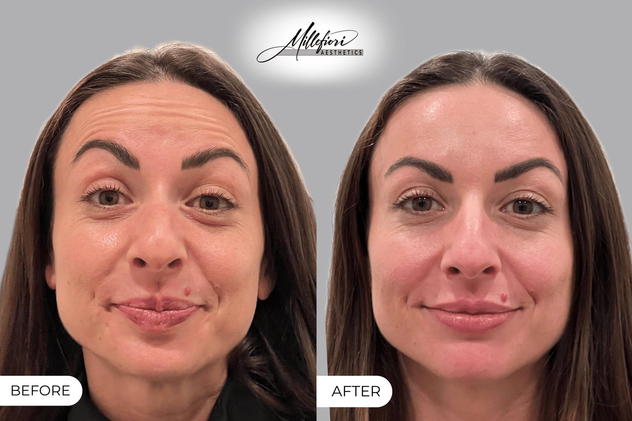 Before and After Image: Botox – Before & After - front
