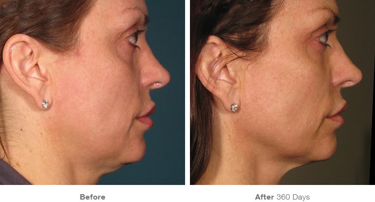 Ultherapy Skin Tightening in Melbourne, FL