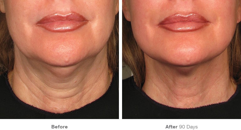 Ultherapy Skin Tightening in Melbourne, FL