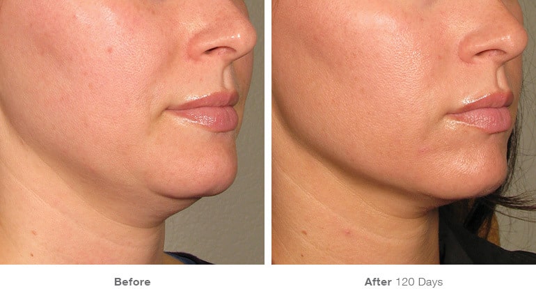 Ultherapy Skin Tightening in Melbourne, FL