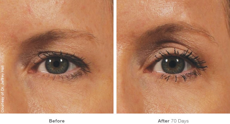 Ultherapy Skin Tightening in Melbourne, FL