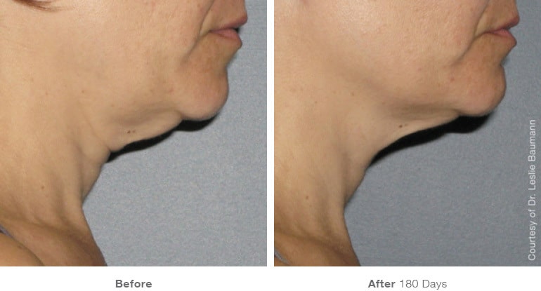Ultherapy Skin Tightening in Melbourne, FL