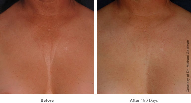 Ultherapy Skin Tightening in Melbourne, FL