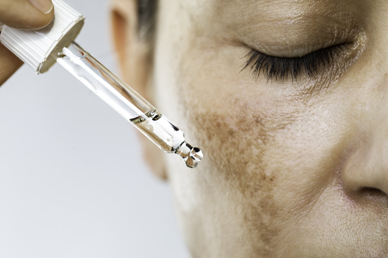Close-up of a woman with melasma, or brown spots, on her cheeks, applying a skin serum to help reduce this.