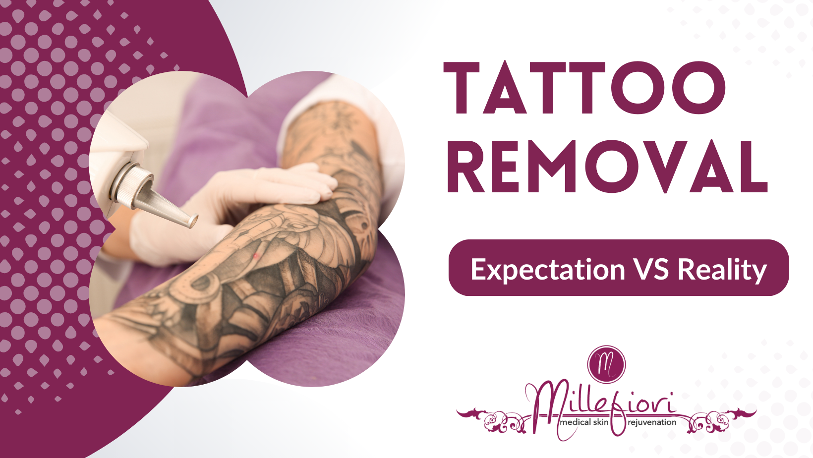 Tattoo Removal Options Are Not All the Same
